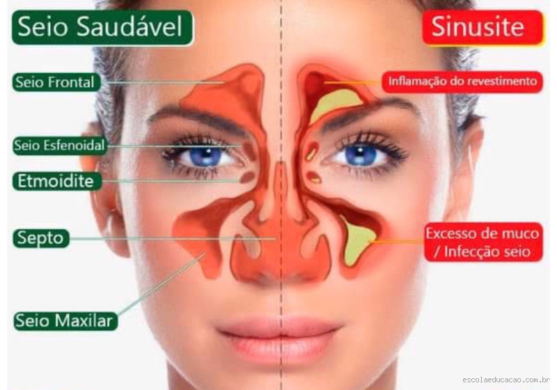 Entenda os Sintomas e Alívio da Sinusite: Como é a Cabeça?