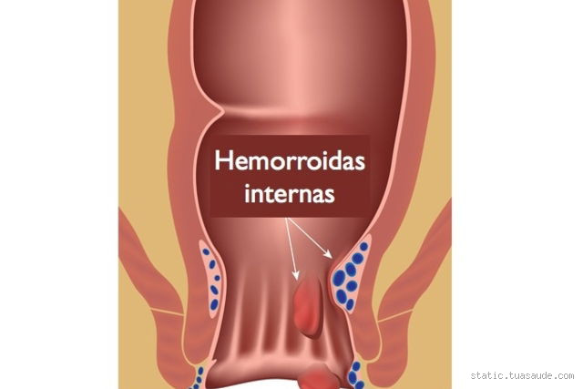 Como é a dor de hemorroida interna?