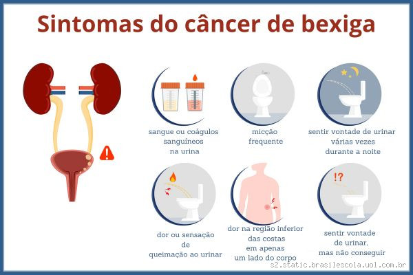 Como é o sangramento de câncer na bexiga? Entenda os sinais e sintomas