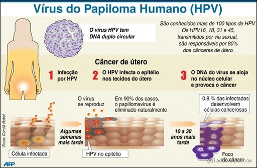 Como saber se o HPV está avançado? Identificando os sinais e tratamentos