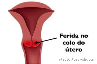 O que Causa Feridas no Colo do Útero? Entenda as Possíveis Causas