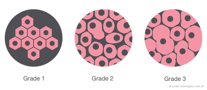 O que é grau 3 no câncer?