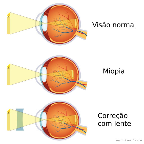 O que é mais comum, miopia ou astigmatismo? Descubra agora!