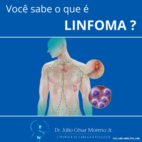 O que é um linfoma nas costas? Sintomas e tratamentos explicados