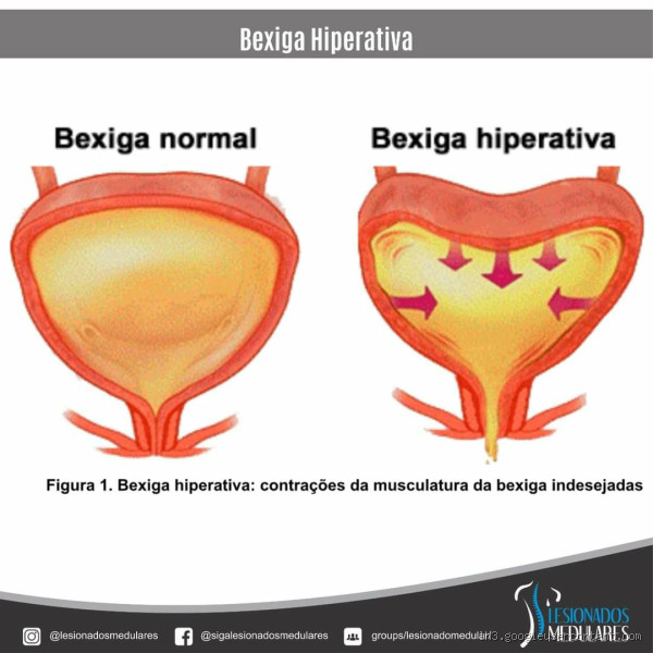 O que é uma bexiga baixa? Entenda os sintomas e tratamentos