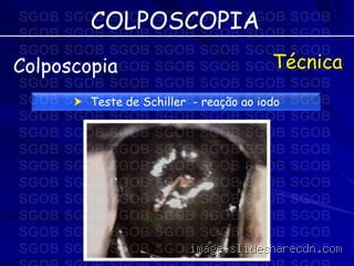 O que quer dizer iodo positivo na colposcopia? Entenda agora!