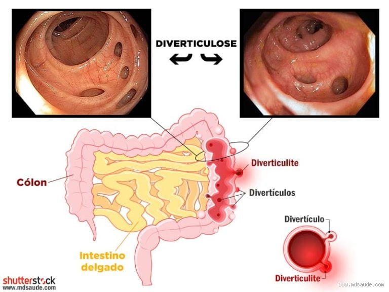 Onde ataca a diverticulite? Descubra os locais e sintomas