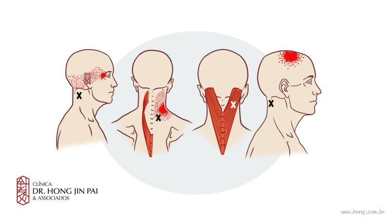 Onde dói a dor muscular? Descubra os pontos mais comuns