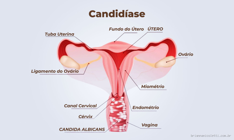 Onde é a coceira da candidíase? Entenda os sintomas e o que fazer