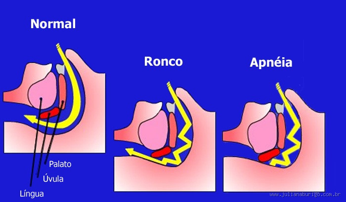 Entendendo os Tipos de Apneia do Sono: Obstrutiva, Central e Mista - Quais São Eles? 🌙💤
