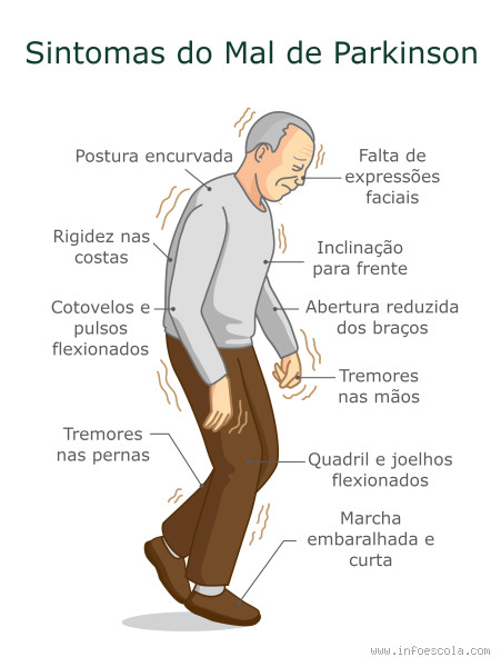 Qual a idade que aparece o mal de Parkinson? Descubra os sinais
