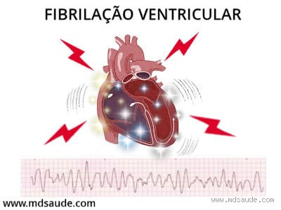 Qual arritmia causa morte súbita?