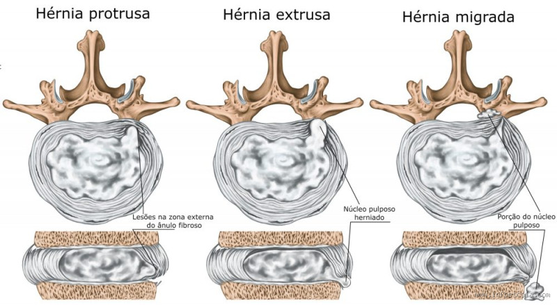 Qual é o tipo de hérnia mais grave? Descubra a verdade