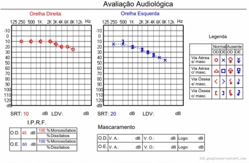 Qual é o normal da audiometria? Descubra os resultados esperados