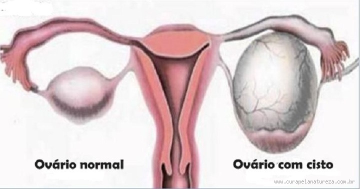Qual o sintoma de um cisto maligno? Sinais que você precisa conhecer