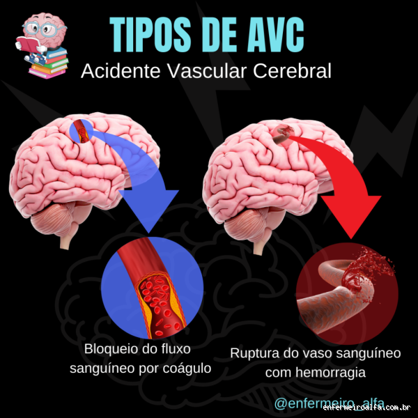 Qual o tipo de AVC mais leve? Entenda a gravidade e os sinais