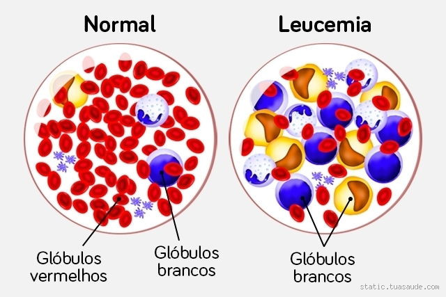 Quando a leucemia aparece?