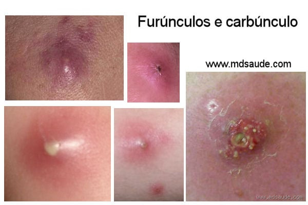 Quanto tempo leva para um abscesso estourar? Tudo o que você precisa saber