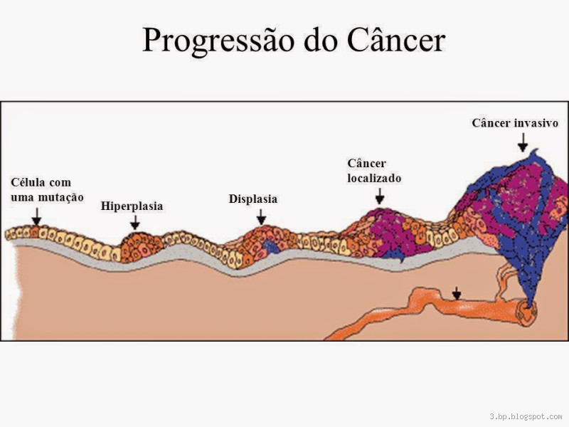 Quanto tempo leva pro câncer se espalhar? Entenda os fatores que influenciam