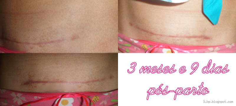 Quantos pontos tem uma cesárea por dentro? Descubra tudo sobre o procedimento