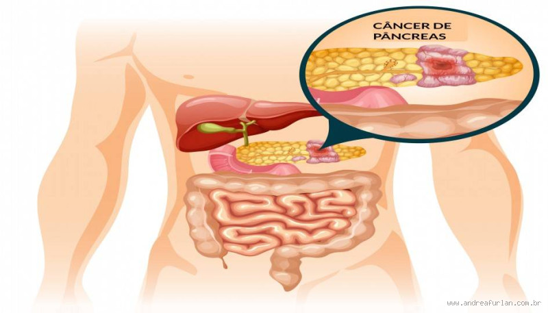 O que causa câncer de pâncreas? Entenda os fatores e riscos