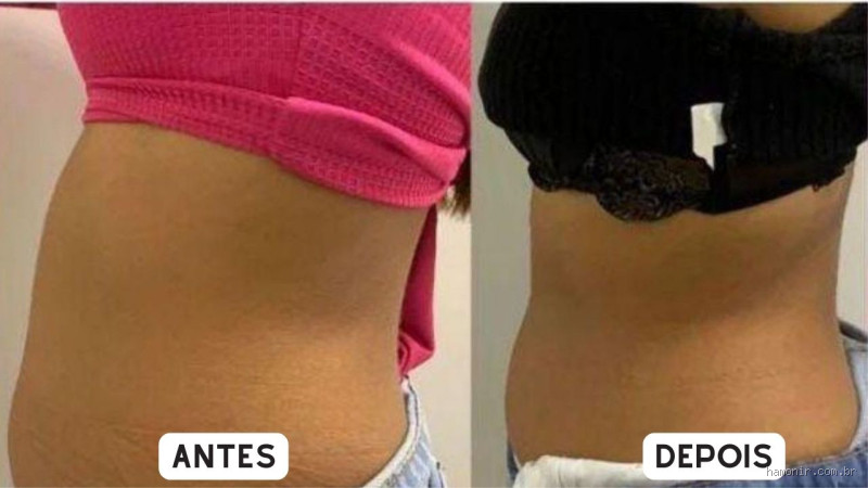 Quem faz criolipólise precisa usar cinta? Entenda tudo sobre o procedimento