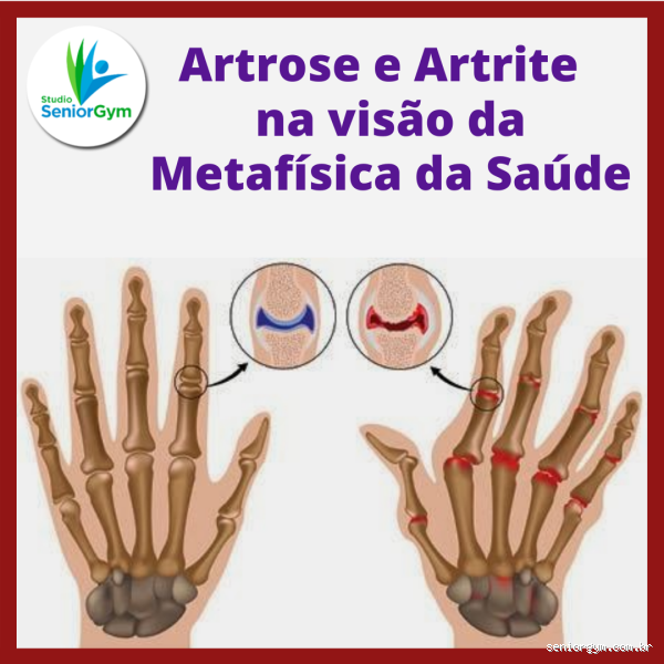Artrose e artrite: Quem tem artrose tem artrite?