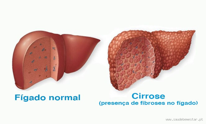 Quem tem cirrose tem vida normal? Entenda o impacto e os cuidados