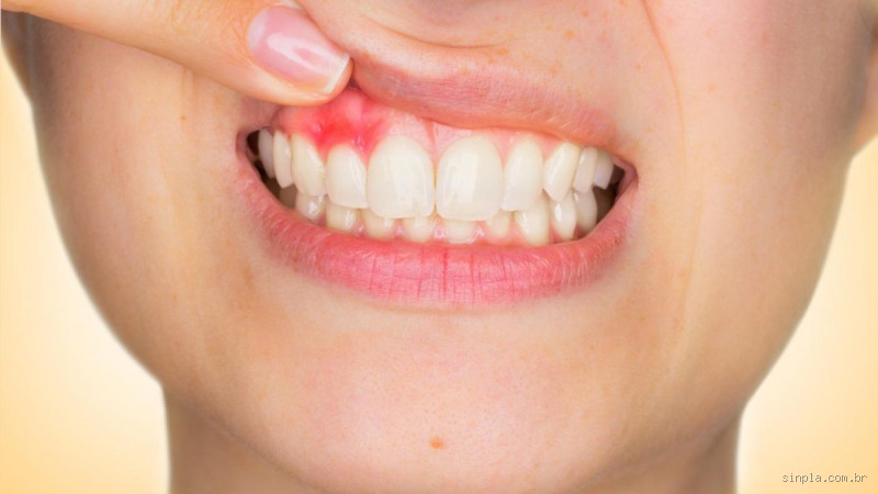 Quando a gengiva inchada no fundo da boca? Descubra as causas e soluções