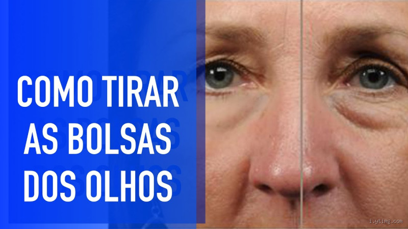 Como Tirar Olheiras e Bolsas embaixo dos Olhos? Dicas Simples e Eficazes