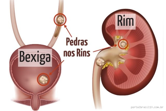 Quem Tem Pedra nos Rins Pode Comer Pipoca? Descubra Agora!