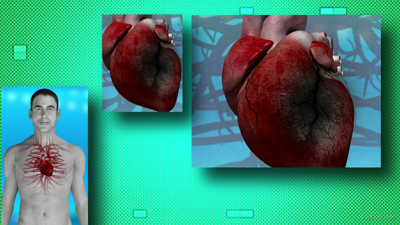 Como a pessoa fica depois de um infarto? Descubra os efeitos reais